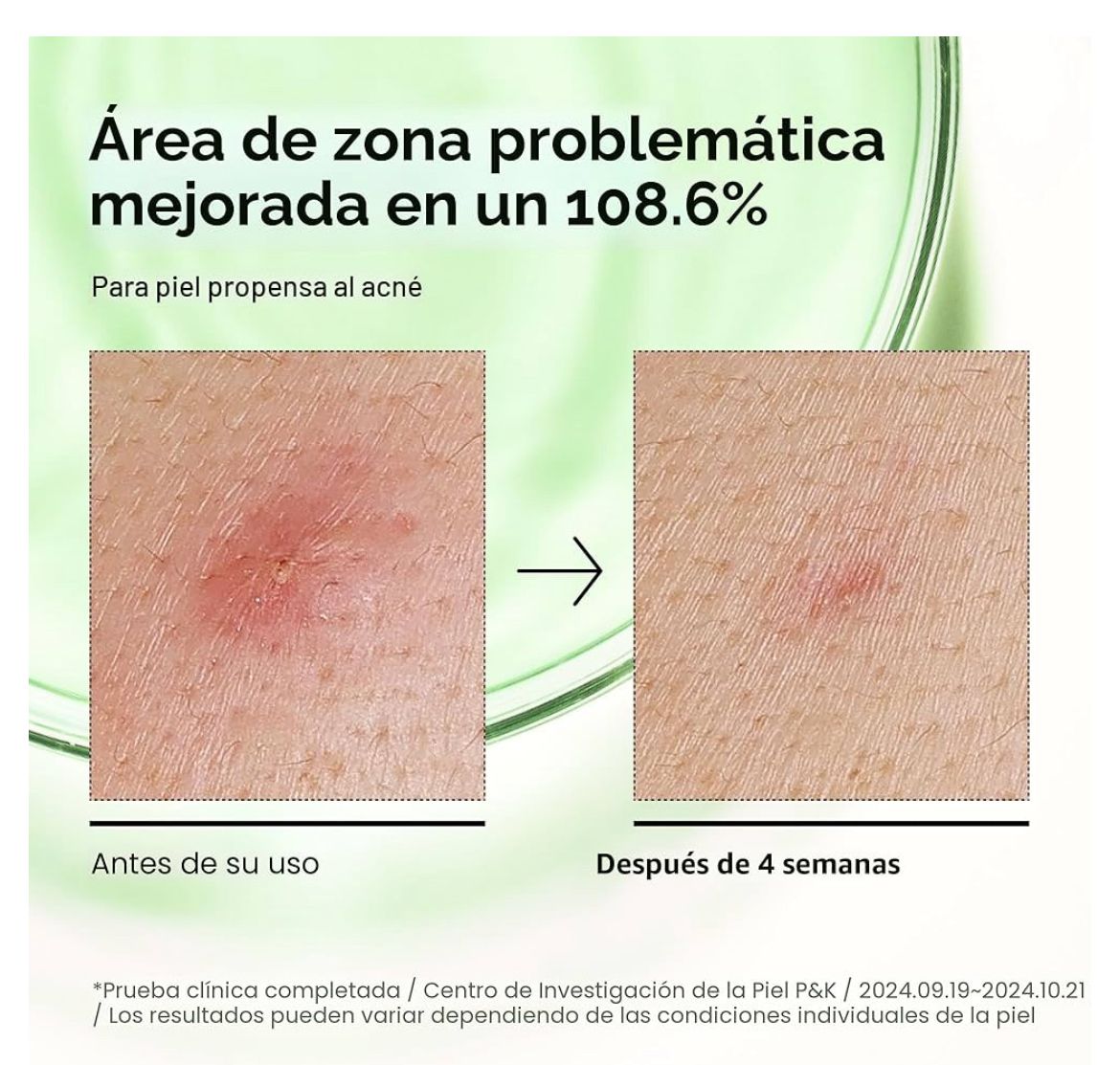 ✨💚 Suero Facial Anti-acné con Ácido Azelaico de Anua 💚