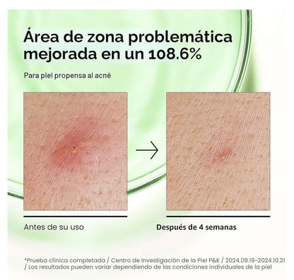 ✨💚 Suero Facial Anti-acné con Ácido Azelaico de Anua 💚
